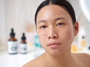 l'impact du cbd sur la santé cutanée : traitement de l'acné, de l'eczéma et du psoriasis